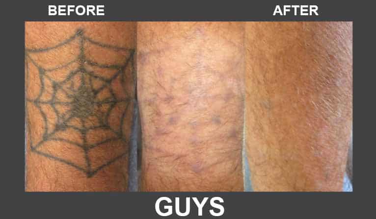 Dr Dohner Before &amp; After Tattoo Removal Pictures - Local 
